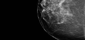 Mamography 2